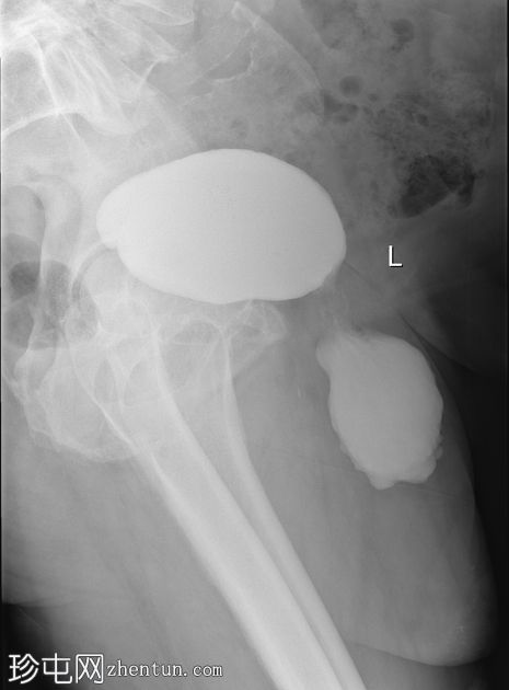 膀胱疝（阴囊膀胱膨出）
