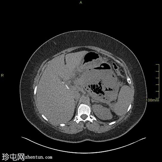 坏死性胰腺炎