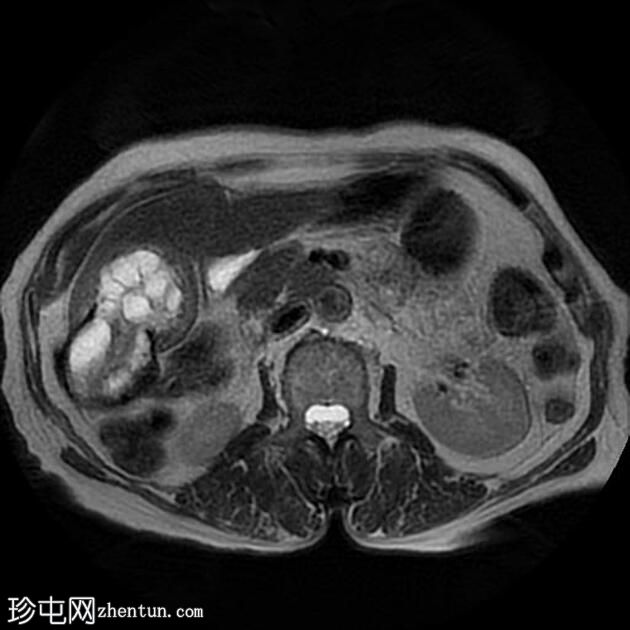 肝包虫囊肿伴胆管内破裂