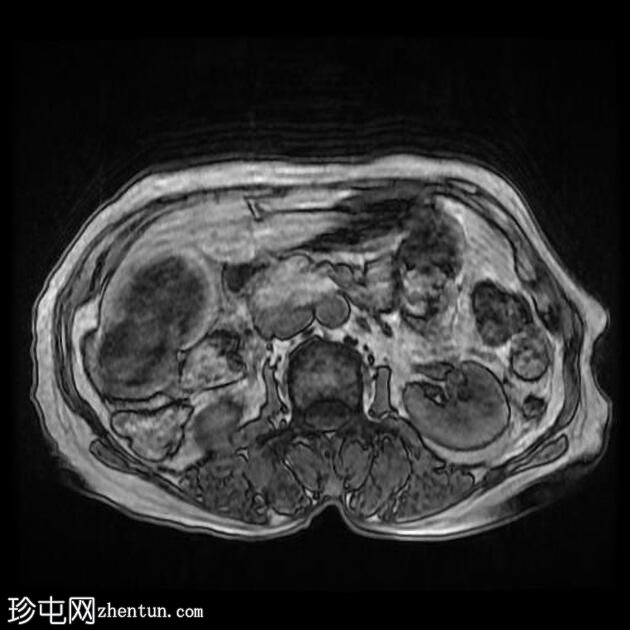 肝包虫囊肿伴胆管内破裂