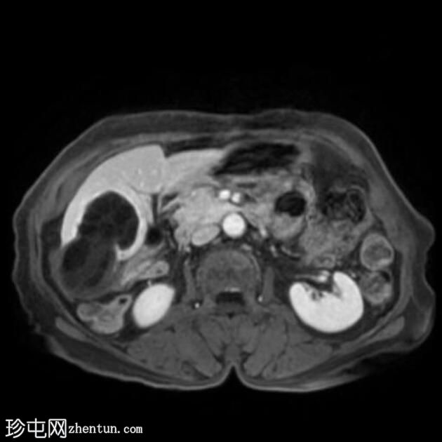 肝包虫囊肿伴胆管内破裂