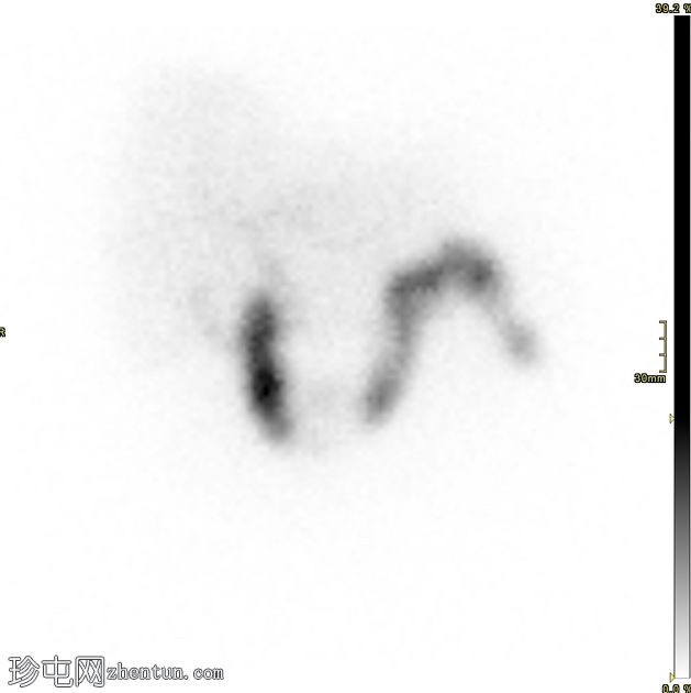 胆漏（肝胆扫描 SPECT-CT）