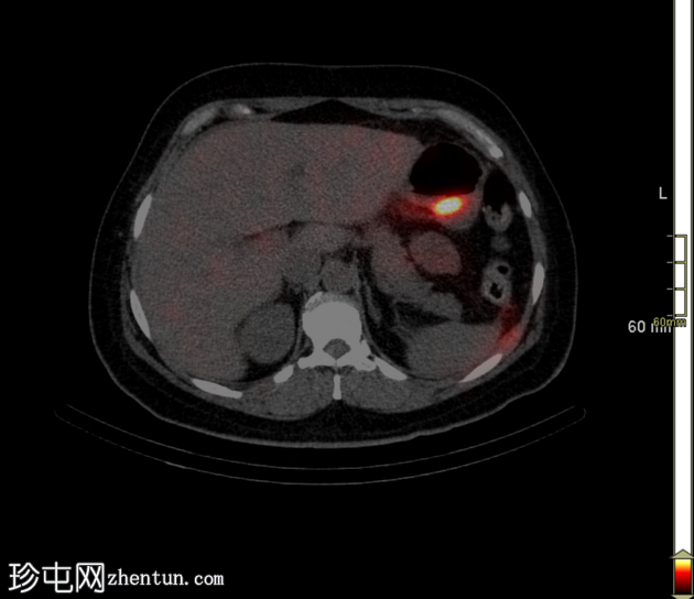 胆漏（肝胆扫描 SPECT-CT）