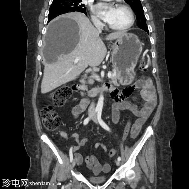 肝脓肿破入胆管系统，引起胆管炎和右肝静脉血栓形成