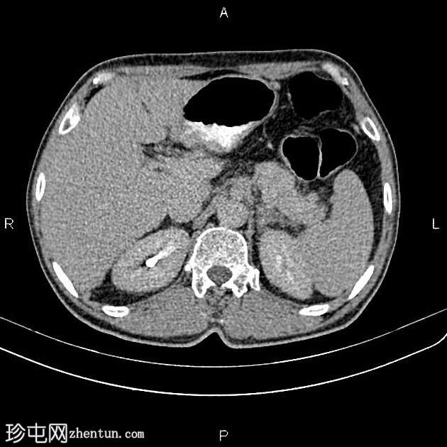 胰腺腺癌