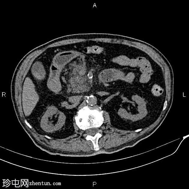 急性坏死性胰腺炎