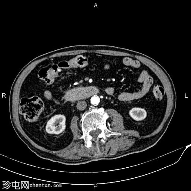 急性坏死性胰腺炎