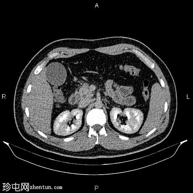 慢性胰腺炎