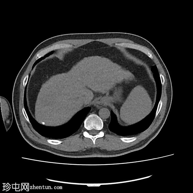 肝细胞癌