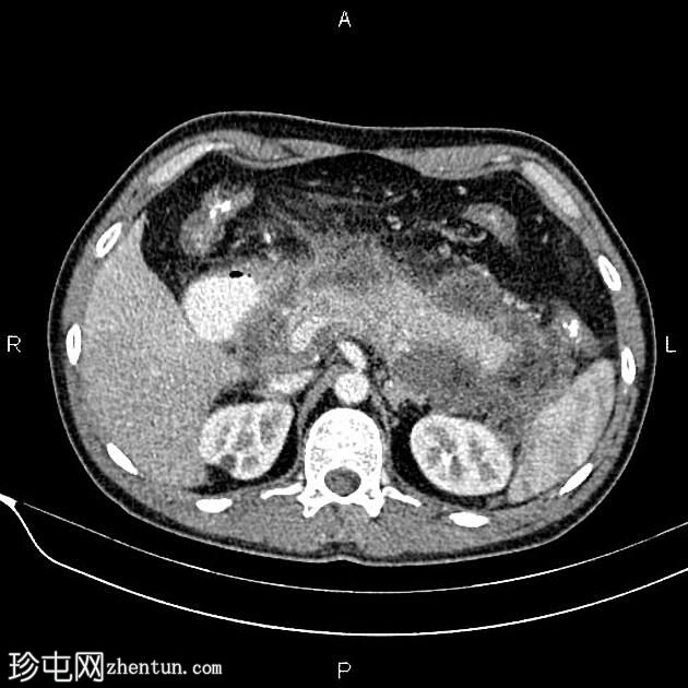 胰腺炎和包裹性坏死