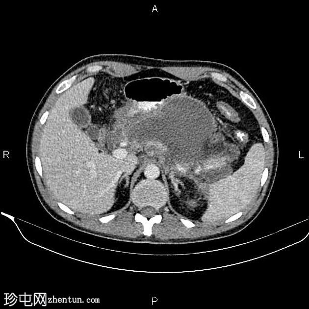 胰腺炎和包裹性坏死