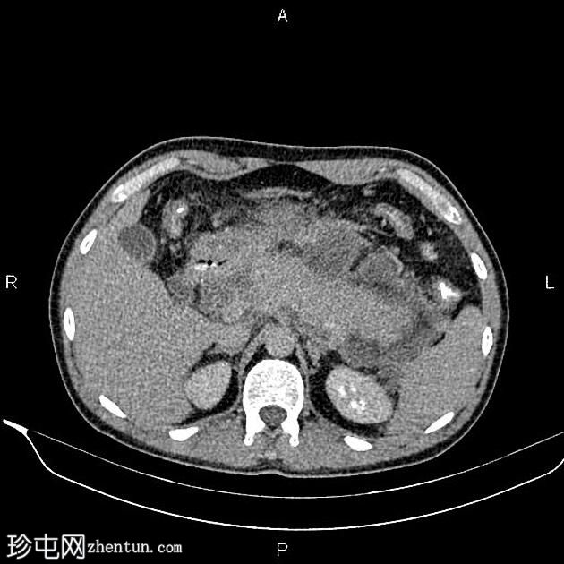 胰腺炎和包裹性坏死