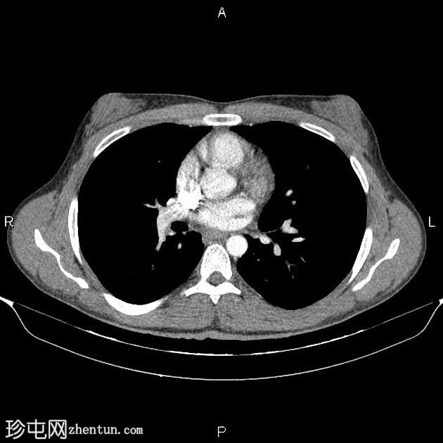 男性乳房发育症（CT）