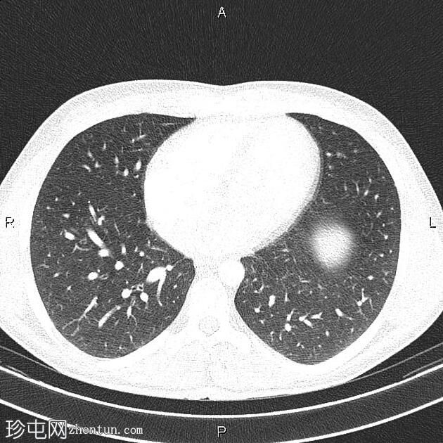 男性乳房发育症（CT）