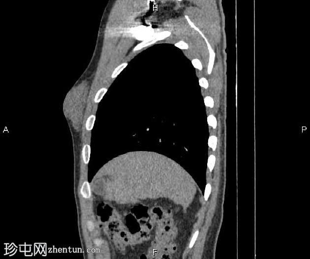 男性乳房发育症（CT）