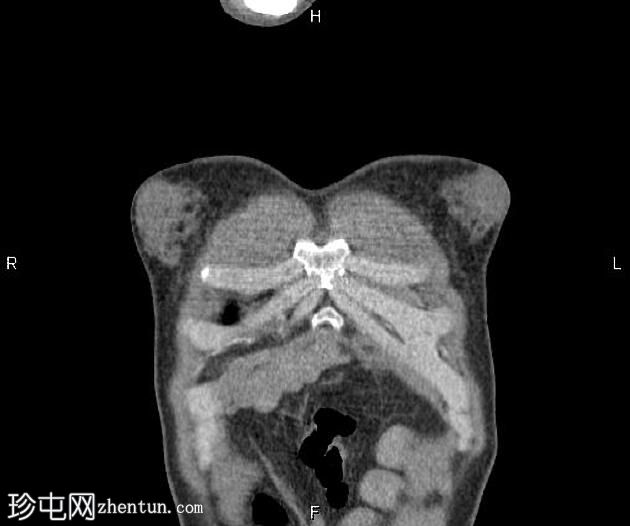 男性乳房发育症（CT）