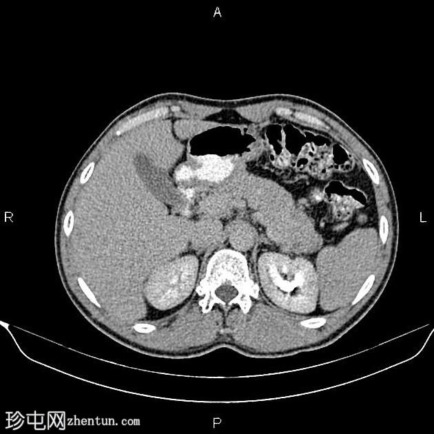 转移性胰腺癌