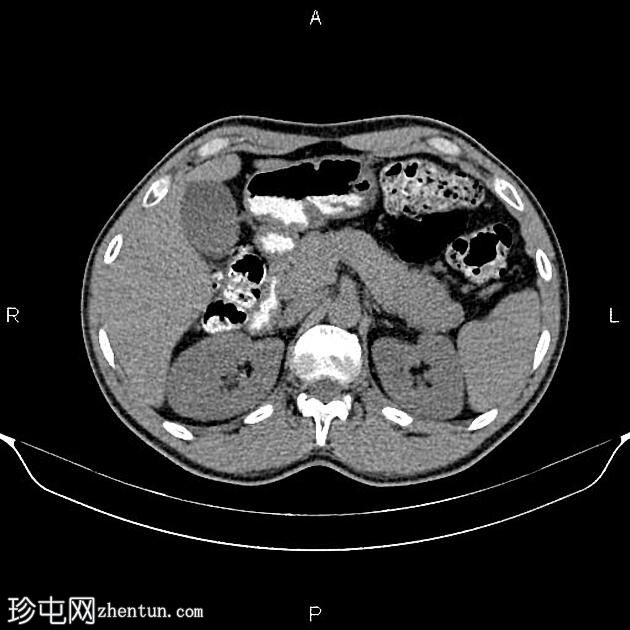 转移性胰腺癌