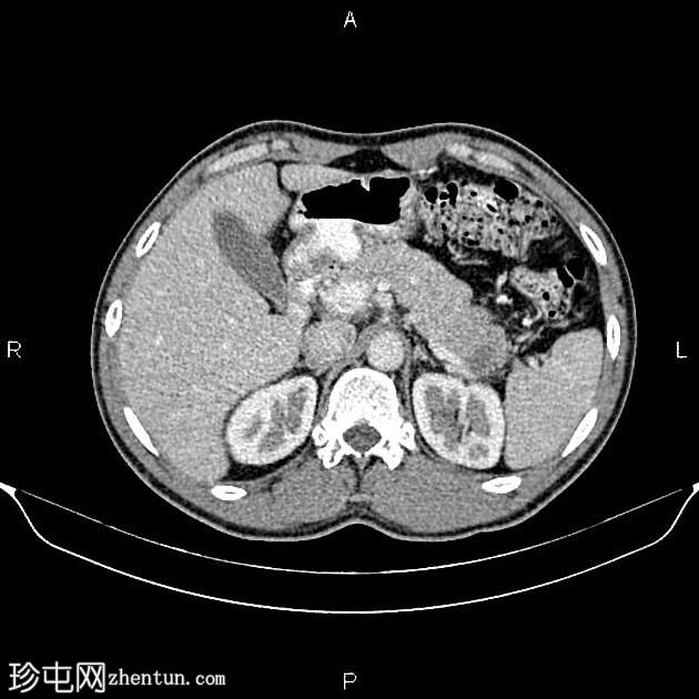 转移性胰腺癌