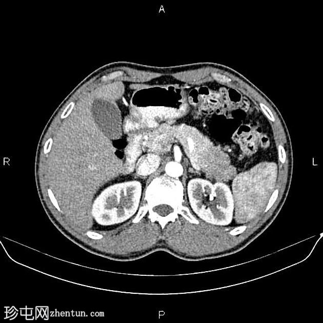 转移性胰腺癌