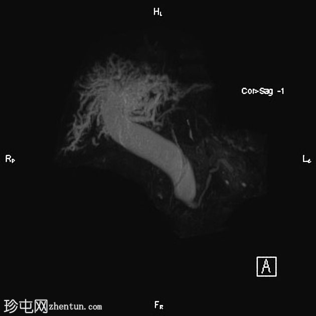 胆总管结石