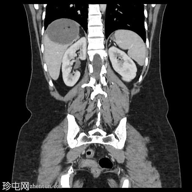 肝包虫囊肿内的脂肪（CT）