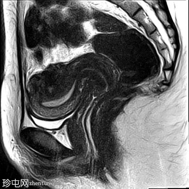 局灶性子宫腺肌病