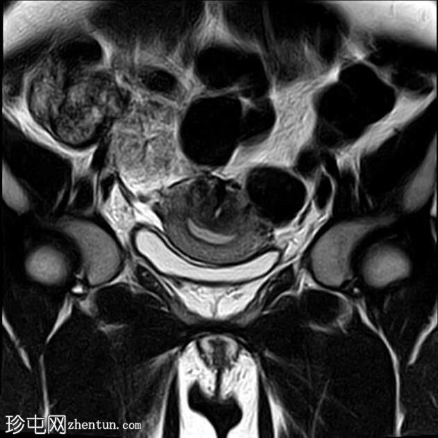 局灶性子宫腺肌病