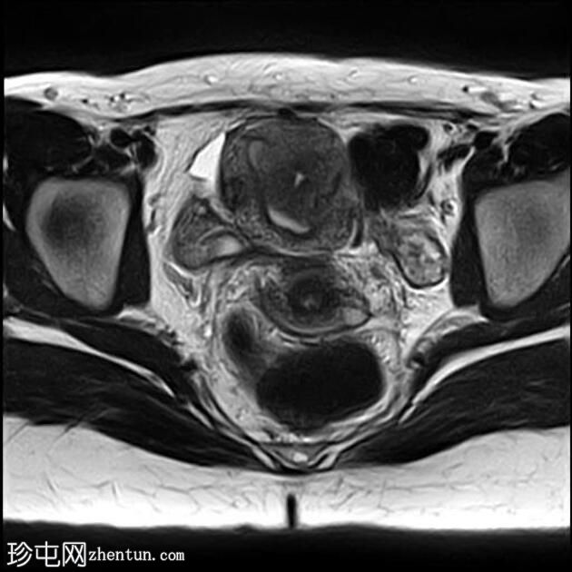 局灶性子宫腺肌病