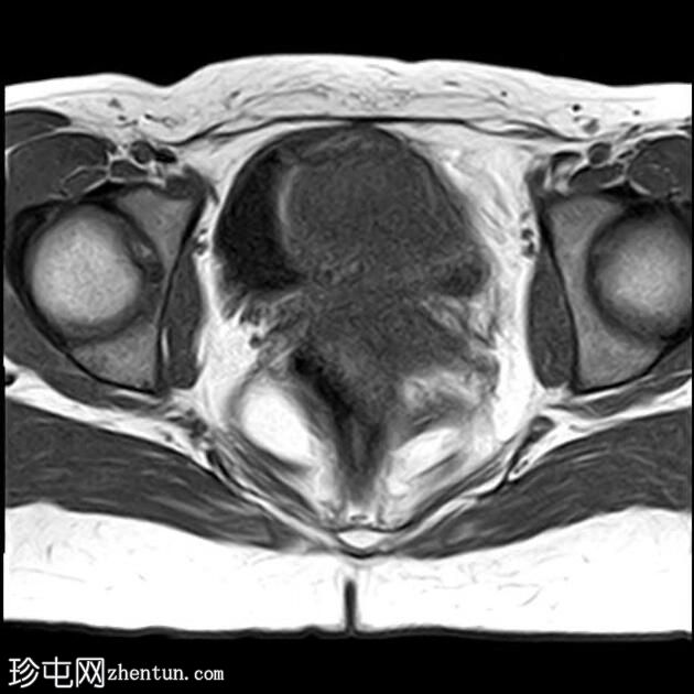 局灶性子宫腺肌病