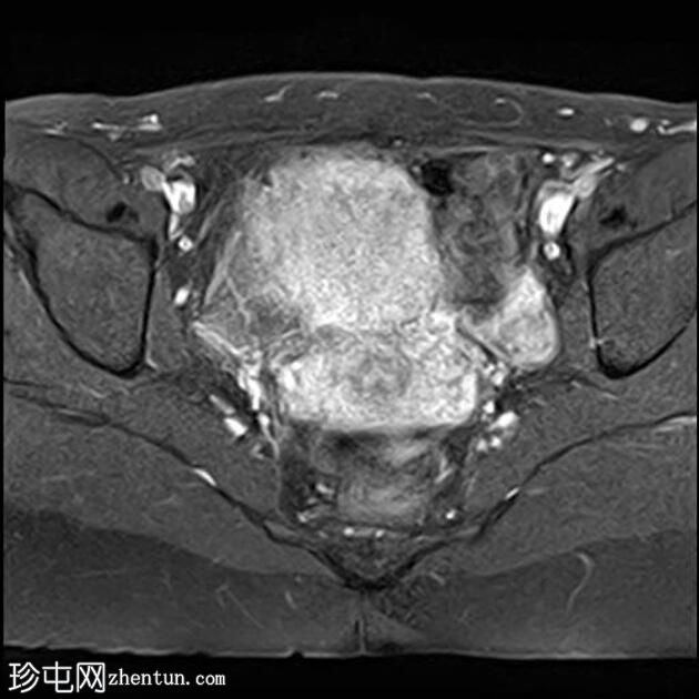 局灶性子宫腺肌病