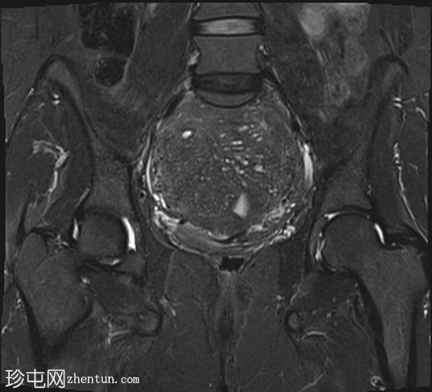 弥漫性子宫腺肌病