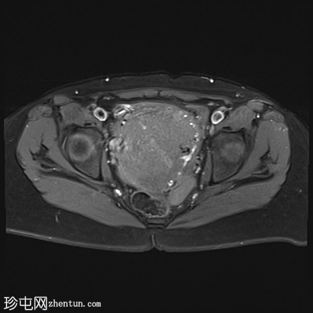 弥漫性子宫腺肌病