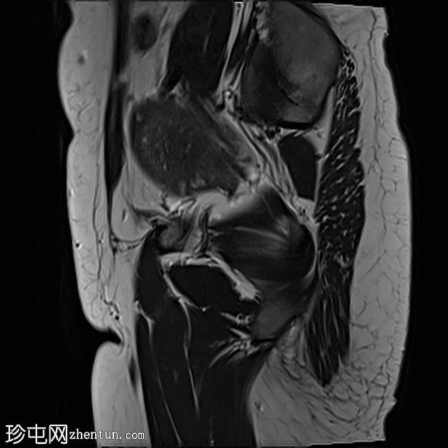 弥漫性子宫腺肌病