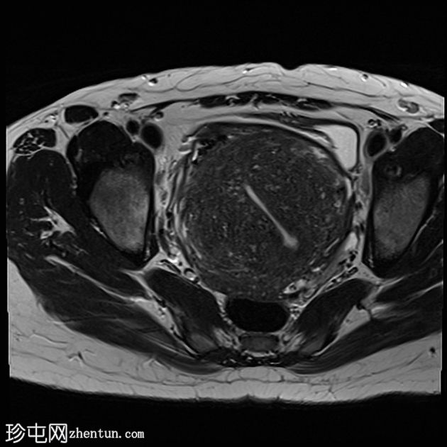 弥漫性子宫腺肌病