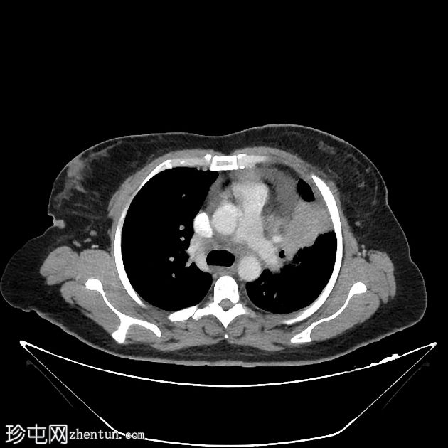 支气管癌