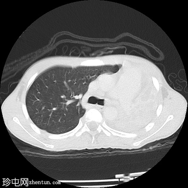 肺炎性肌纤维母细胞瘤