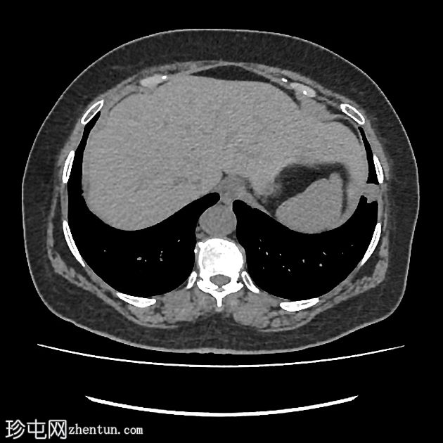 肺动静脉畸形 - 非增强 CT