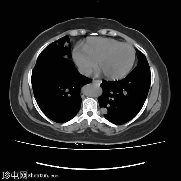 肺动静脉畸形 - 非增强 CT