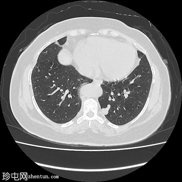 肺动静脉畸形 - 非增强 CT