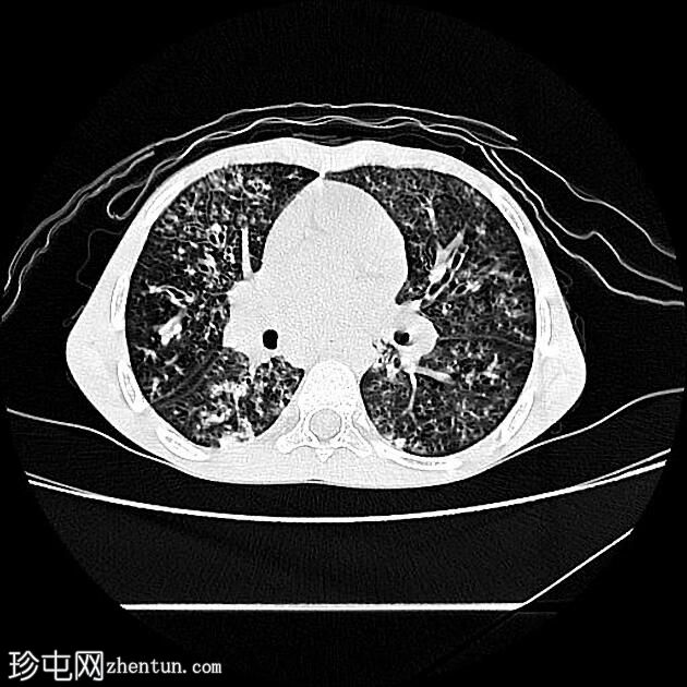 囊性纤维化