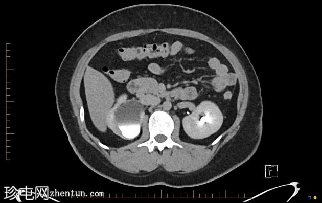 双侧双肾及收集系统