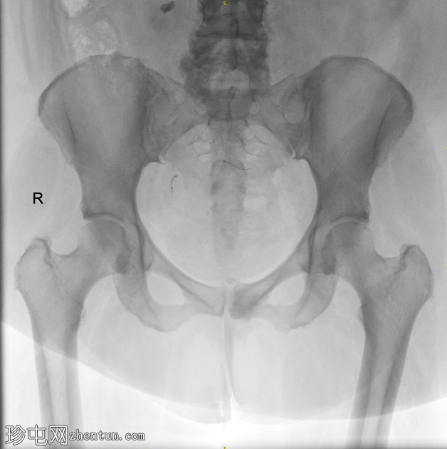 Essure 灭菌植入物