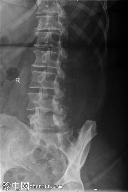 Essure 灭菌植入物