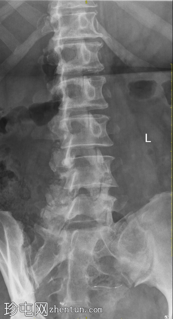 Essure 灭菌植入物