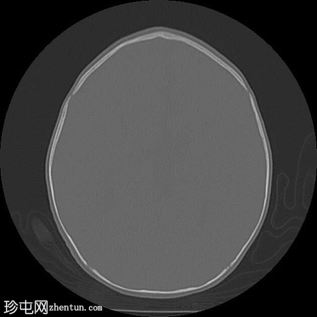 三角头畸形伴胼胝体发育不全