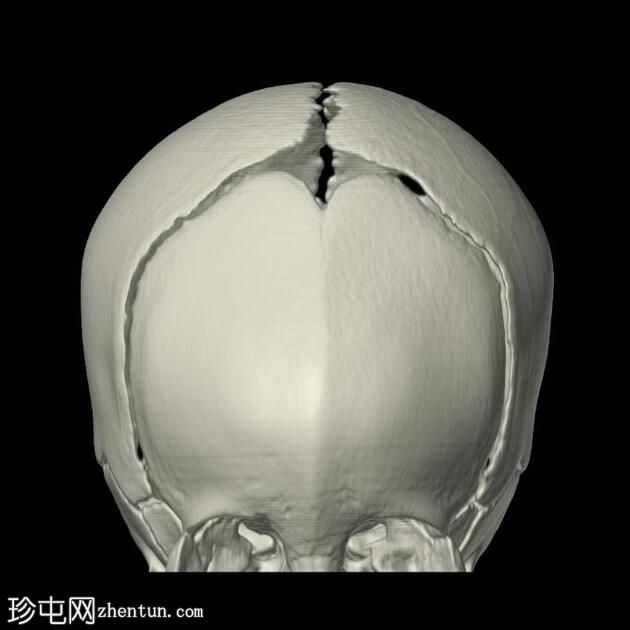 三角头畸形伴胼胝体发育不全