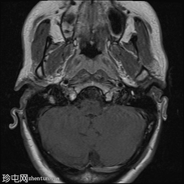 急性面神经炎