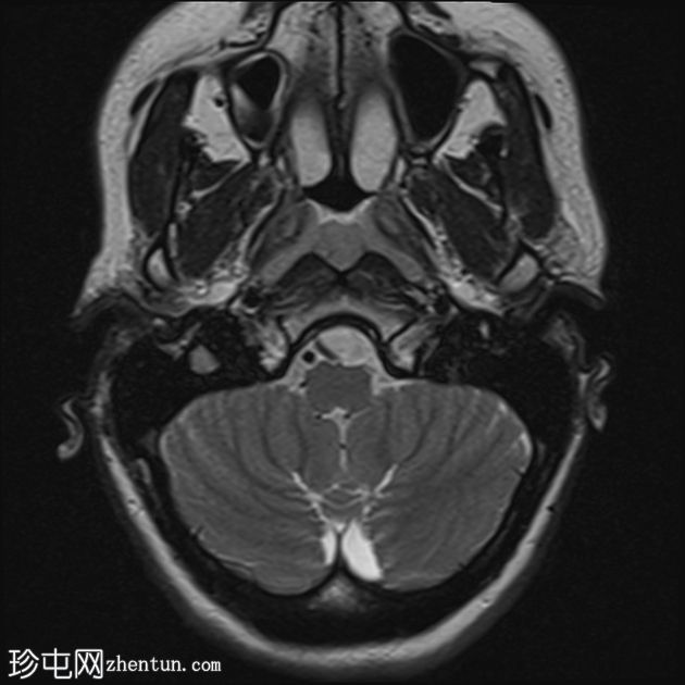 急性面神经炎