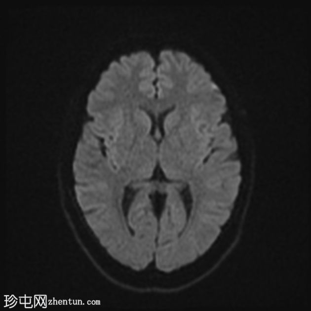 急性面神经炎